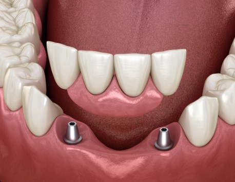 A Comprehensive Guide To Dentures, Complete Denture Handbook, Denture Mastery Manual, AllInclusive Denture Encyclopedia, Ultimate Denture Compendium, Comprehensive Denture Tutorial, Denture Handbook, InDepth Denture Guide, Total Denture Overview, Denture Expertise Compendium, Full Denture Walkthrough, Denture Encyclopedia, Denture Instruction Manual, Denture Mastery Guide, Comprehensive Prosthodontics Handbook, Denture Education Compilation, Complete Prosthetics Tutorial, Denture Care Compendium, Denture Fitting Manual, Denture Solutions Encyclopedia, AllEncompassing Dental Prosthetics Guide, Comprehensive Denture Knowledge Base, Denture Expert